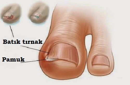 Tırnak Batması İçin Evde Deneyebileceğiniz 6 Tedavi