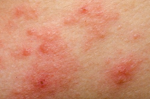 dermatit
