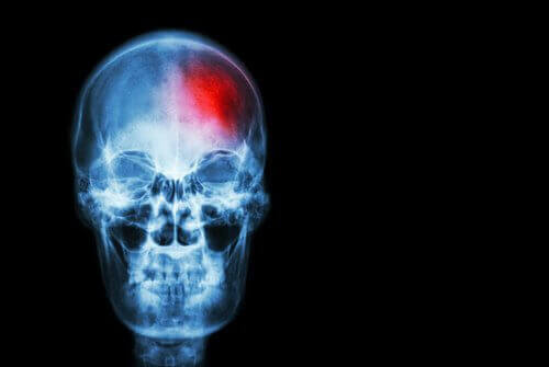 Beyin Kanaması Belirtileri Hakkında Bilmemiz Gerekenler