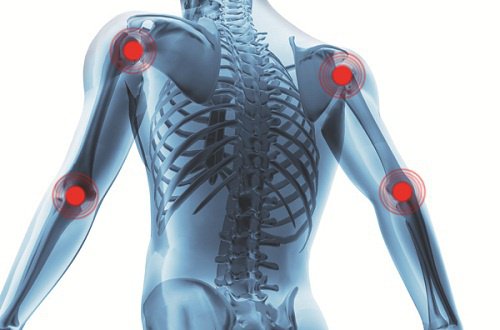 Artritle Savaşmak İçin Tüketebileceğiniz Doğal Gıdalar