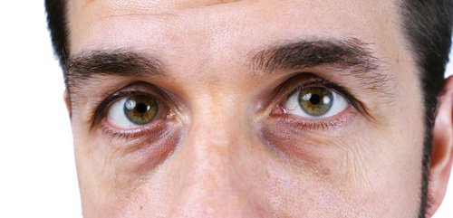 Gözlerin Altındaki Koyu Halkalar için 4 Doğal Çözüm