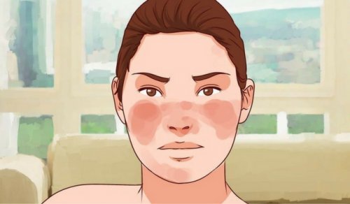 Lupus Hastalığı ve Bu Durumu Kontrol Etmek İçin 7 Reçete