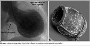 Kırık kalp sendromu