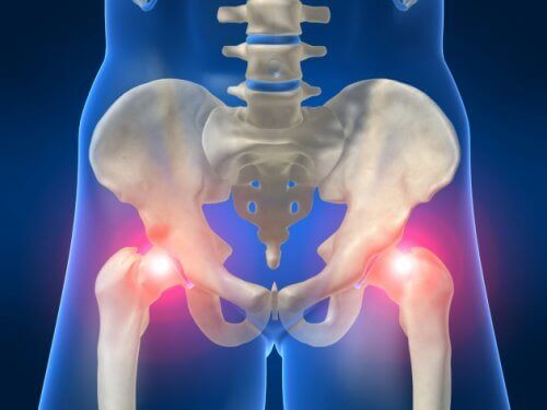 osteoartrit kalça röntgeni