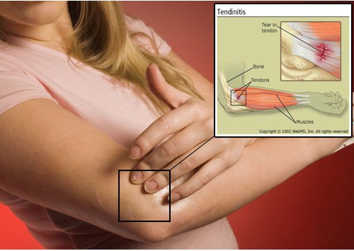 tendon iltihabı