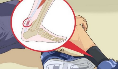 Aşil Tendonu Tedavisi için 5 Yöntem