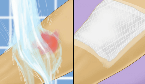 Kaynar Su Yanıkları İçin İlk Yardım