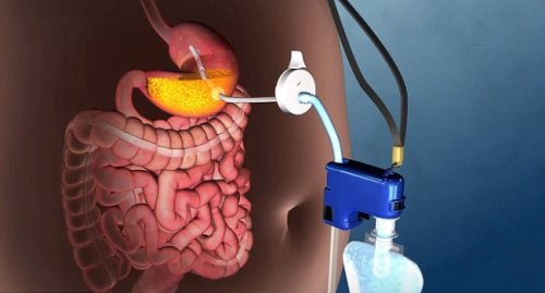 Obezitede Ameliyatsız Tedavi İmkanı Sunan Yeni Bir Teknik