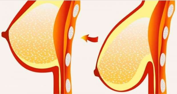 Sarkan Göğüsler için 8 Tedavi ve Öneri