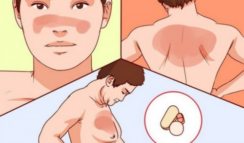 Lupus (Deri Veremi) Hakkında Bilmeniz Gerekenler