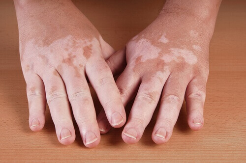vitiligo eller
