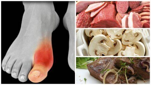 Gut Hastalığı (Nikris) ve Kaçınmanız Gereken 7 Gıda