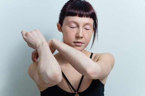 vitiligo dirsek