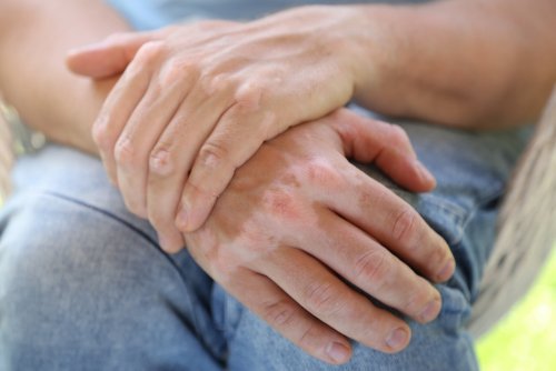 Vitiligo İçin 9 Doğal Tedavi