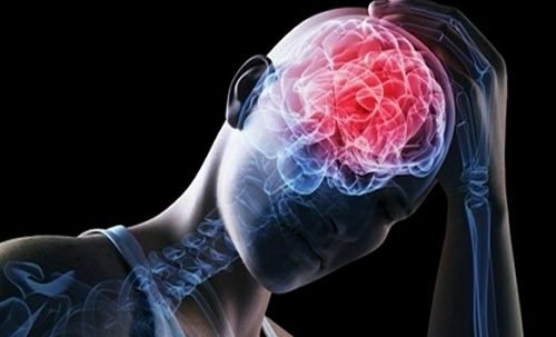 beyin damar hastalıkları