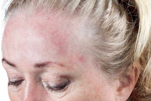 dermatit