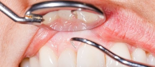 Dişlerinizi Fırçalarken Diş Eti Kanaması İçin 14 Neden