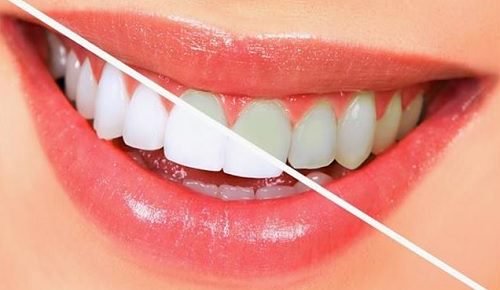 Dişlerinizi Beyazlatan Yiyecekler: Doğal Diş Beyazlatma