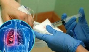 Bilim İnsanları Akciğer Kanseri Tedavisinde Kemoterapinin Yan Etkilerini Azaltan Bir İlaç Keşfetti