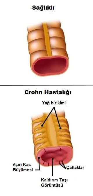 crohn hastalığı
