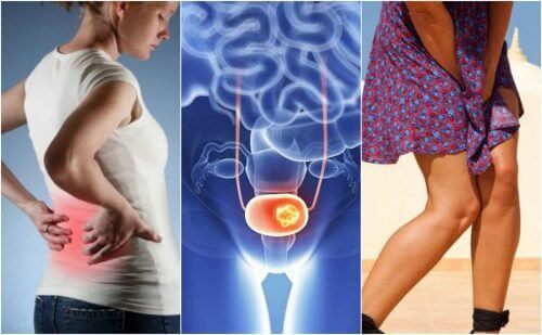 Mesane Kanseri ve Dikkat Edilmesi Gereken 7 Belirtisi