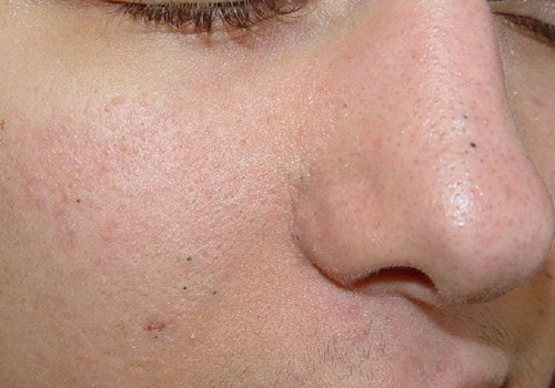 Siyah Noktalardan Kurtulmak İçin Ev Yapımı 3 Eksfoliant