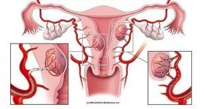 Fibroidler ve Bu Durumu Gösteren 7 Uyarıcı İşaret