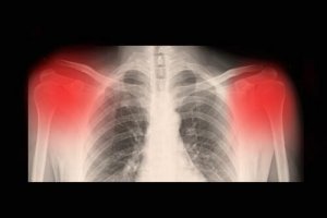 Osteoartrit Hastalığı ile İlgili Bilmeniz Gereken Her Şey