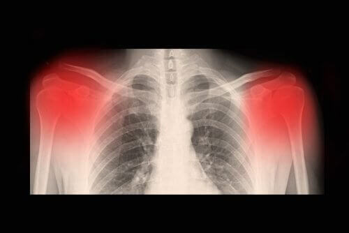 Osteoartrit Hastalığı ile İlgili Bilmeniz Gereken Her Şey