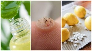 Siğil Tedavisinde Etkili Bu Tarifleri Mutlaka Deneyin!