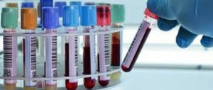 Depresyon Teşhisi İçin Kan Testi
