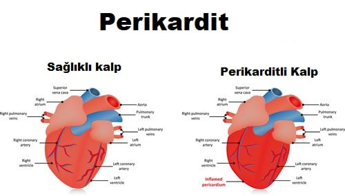 sağlıklı ve perikarditli kalp