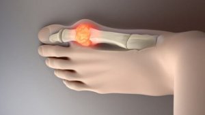 Ürik Asidi Düşürmek İçin 8 İdeal Gıdayı Deneyin