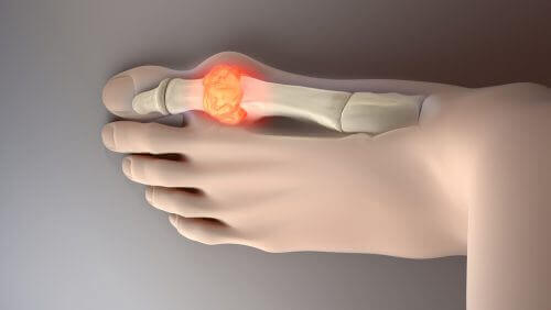 Ürik Asidi Düşürmek İçin 8 İdeal Gıdayı Deneyin