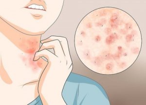 Evde Uyuz Hastalığından Kurtulmanın 3 Yolu