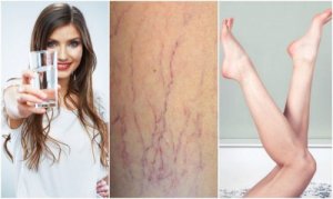 Varisli Damarları Önlemek İçin Bu 6 İpucunu Okuyun