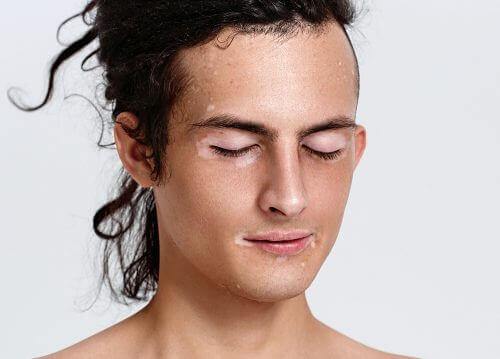 yuzde vitiligo leke