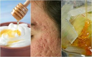 Sivilce İzlerini Gidermek İçin Kullanabileceğiniz 5 Maske