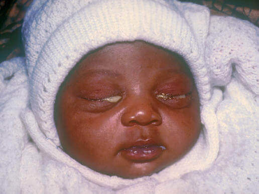 bebeklere geçen cinsel hastalıklar