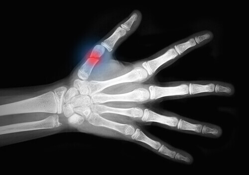 Osteoporoz röntgeni