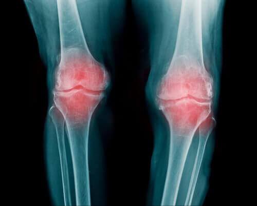 osteoartrit hakkında daha fazlası