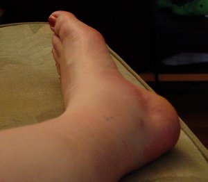 Şişmiş Ayak Bileklerinizin Ortaya Çıkarabileceği 5 Uyarıcı İşaret