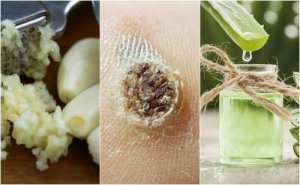 Siğillerle Savaşmak İçin 5 Doğal Reçete