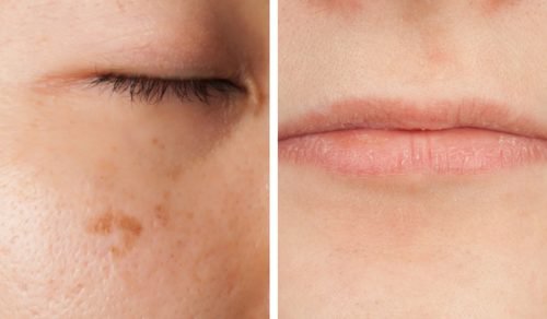Yüzünüzün Vitamin Eksikliği Hakkında Sizi Uyarmakta Olduğu Beş Durum