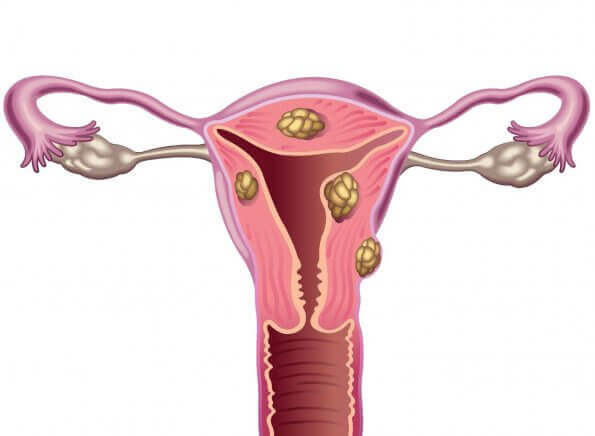 yumurtalık ve fibroid