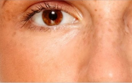 kadın suratı çillenme