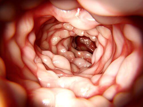 Crohn Hastalığını Tedavi Etmek İçin Bilmeniz Gerekenler