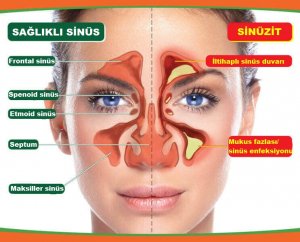 Sinüzitin Belirtileri: Başlangıçtan Teşhise