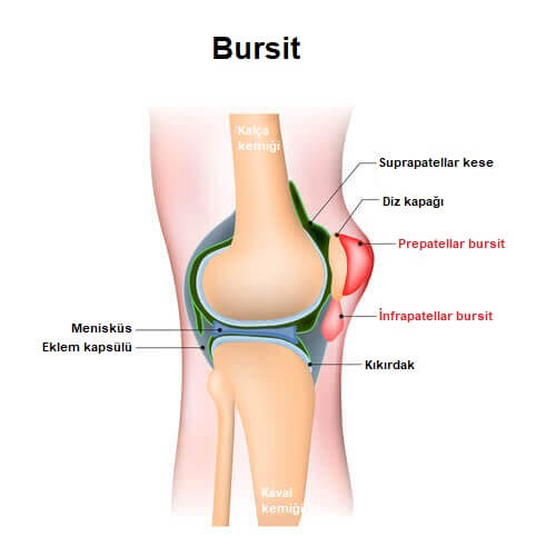 bursit (bursitis)