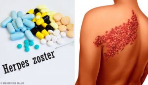 Zona Hastalığı Belirtileri ve Teşhisi